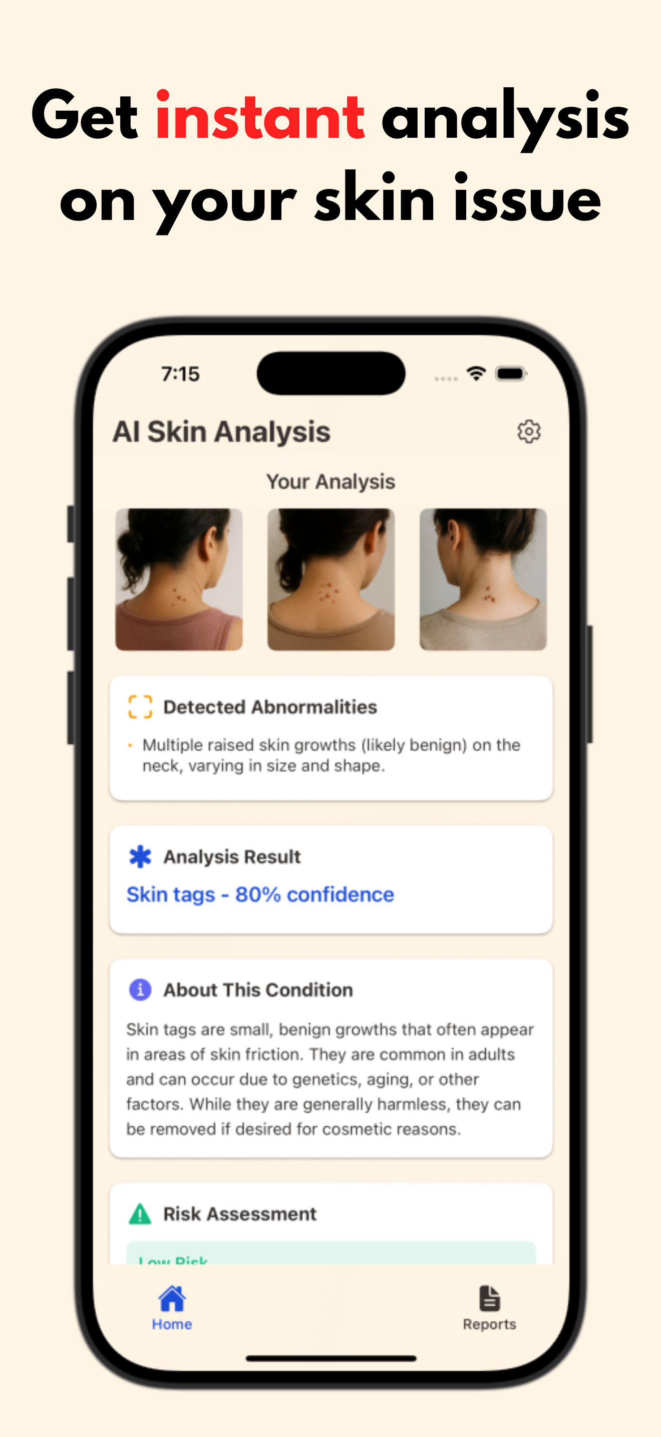 Rash Detector app analyzing a rash